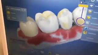 CEREC 4.5 Software Preview