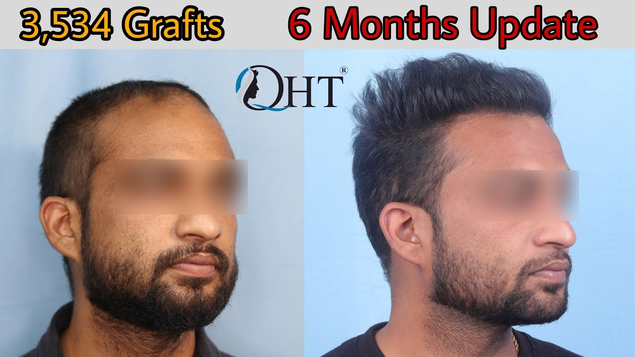 Amazing Transformation @Regrow Clinic || ​6 months Update of Hair Transplant  || QHT || 3,534 Grafts - YouTube