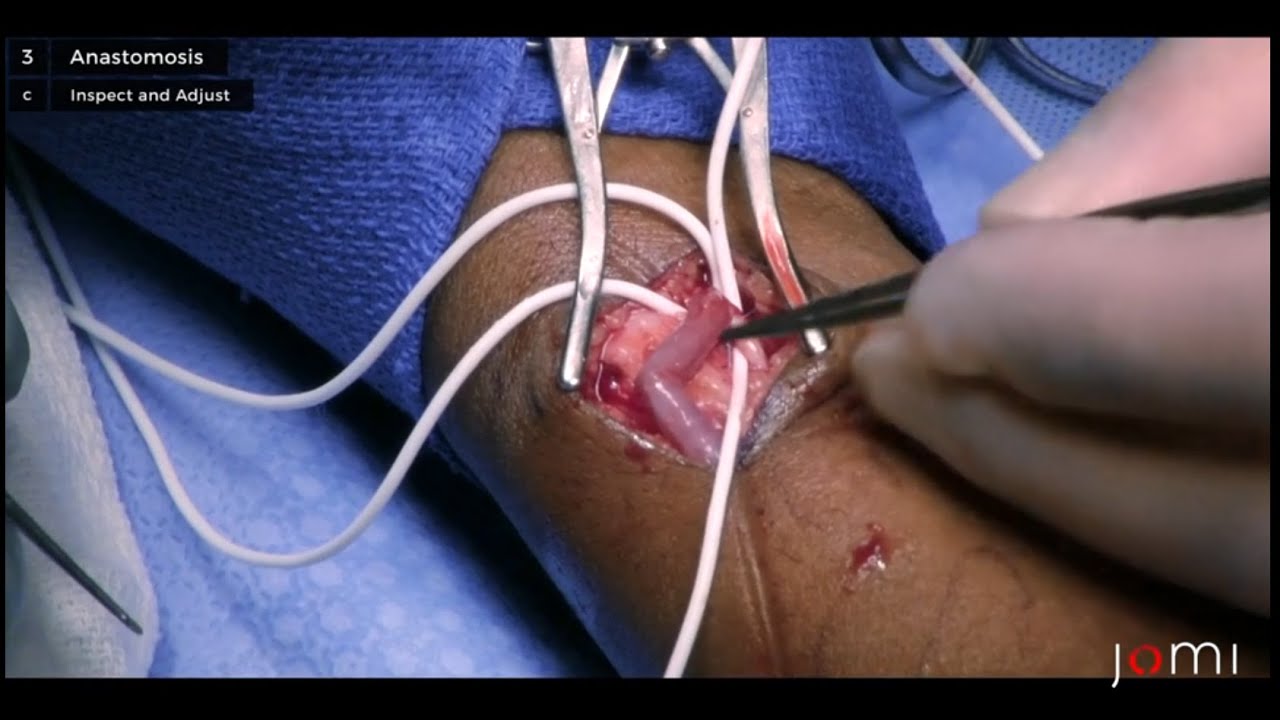 Arteriovenous Fistula Creation Links To Full Procedure Youtube