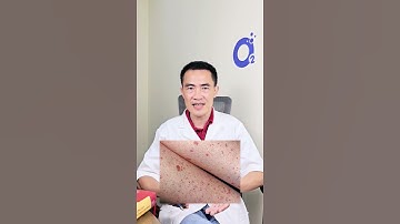 Những Lưu Ý Đặc Biệt Khi Điều Trị Sốt Xuất Huyết Tại Nhà | SKĐS #shorts