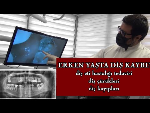 Video: Neden Diş Kaybını Hayal Et