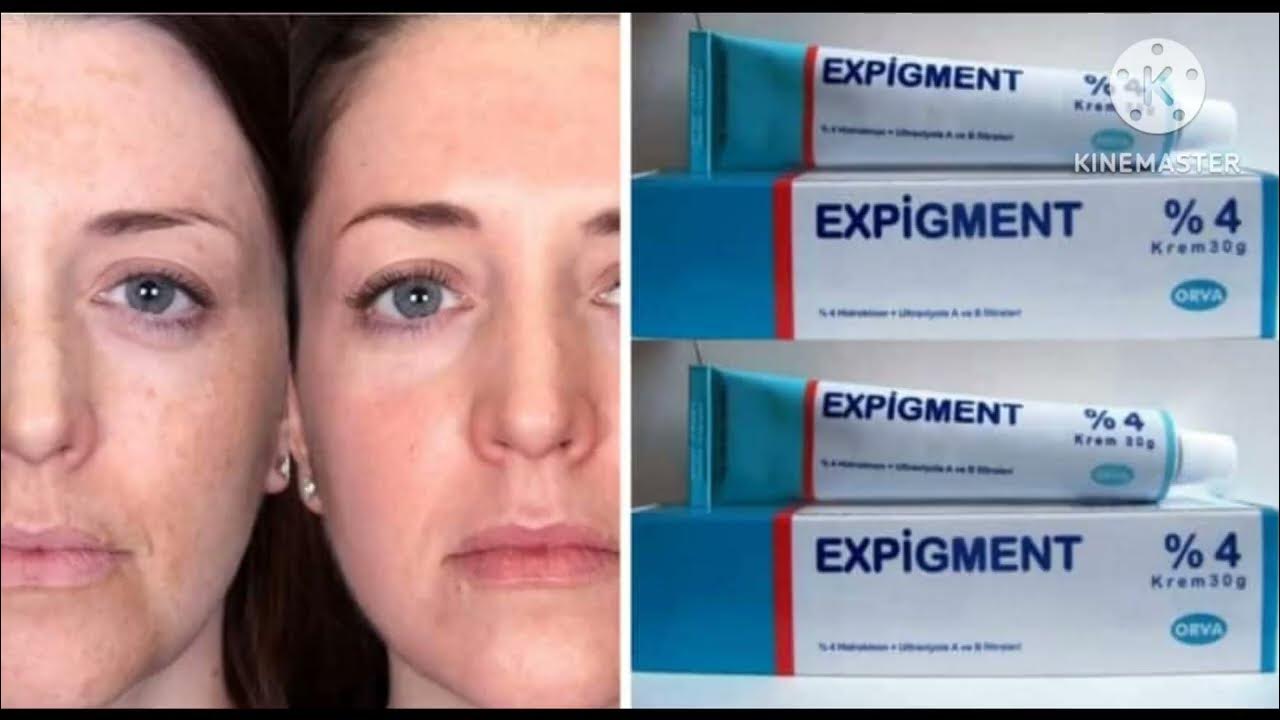 Expigment с содержанием гидрохинона 4% - YouTube
