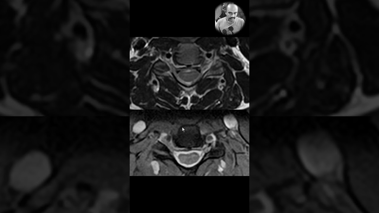MRI Cervical Spine - the Routine T2, MEDIC or MERGE? Which one do you like?