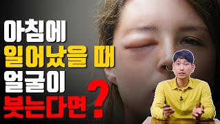 아침에 일어났을 때 얼굴이 붓는다면? [방태환 원장의 5분 건강정보]