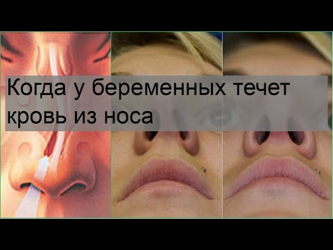 Когда у беременных течет кровь из носа