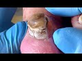 Towering Thick Nails! Old Man Crying For Help
