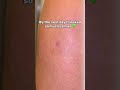 Tiny Red Bumps on Your Shoulders? It Could Be Folliculitis