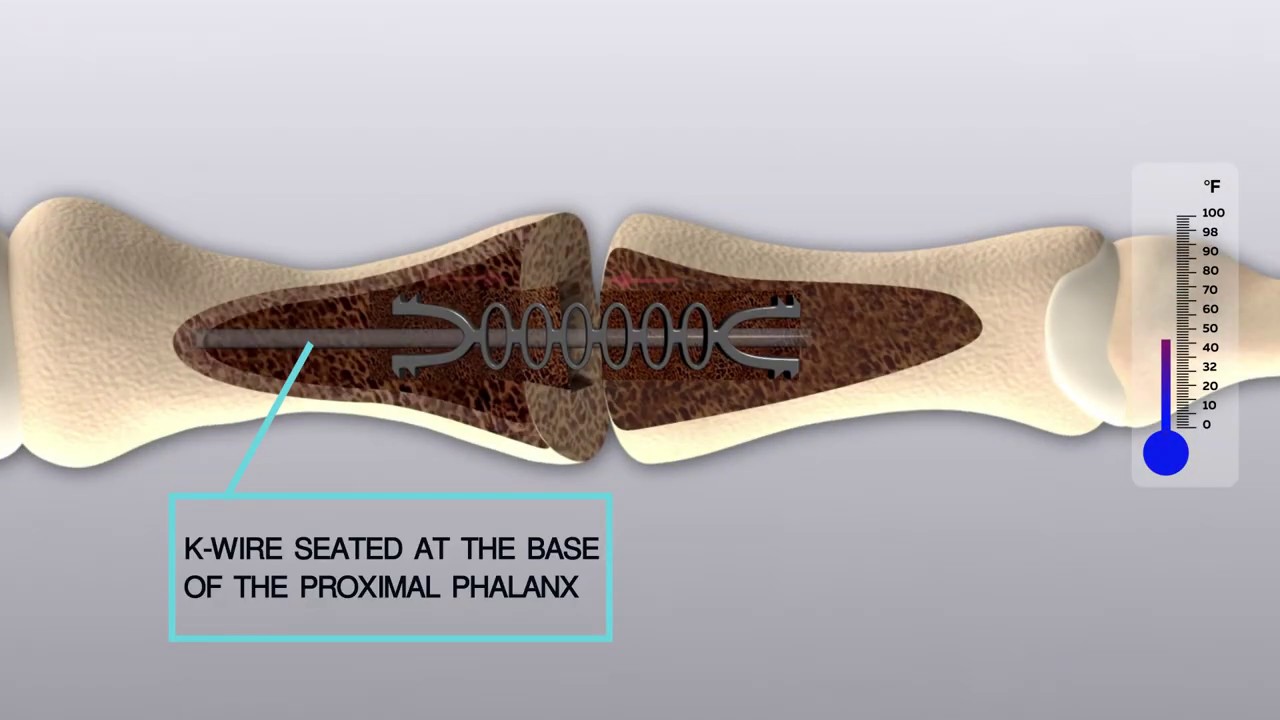 Hammertoe Surgical Implant Device YouTube