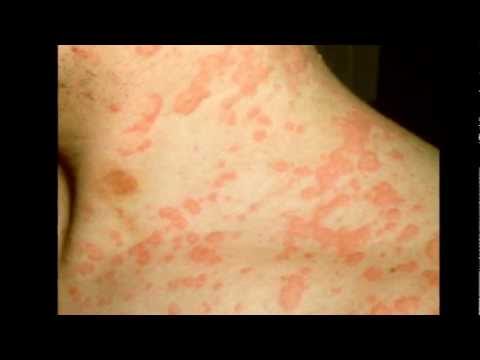 Natural Home Remedies For Urticaria - Hives Treatment