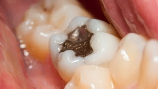 Amalgam Dental Filling