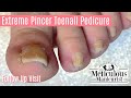 👣Extreme Pincer Bat Ear DIY Pedicure at Home Follow Up👣