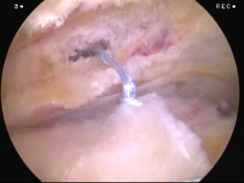 Arthoscopic view of suture placement in the torn tendon - YouTube