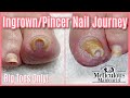 👣Big Toes Only - Ingrown/Pincer Impacted Toenail Pedicure Transformation👣