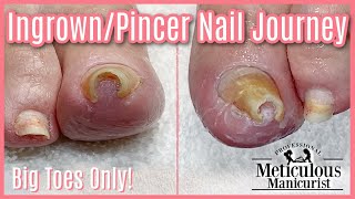 👣Big Toes Only - Ingrown/Pincer Impacted Toenail Pedicure Transformation👣