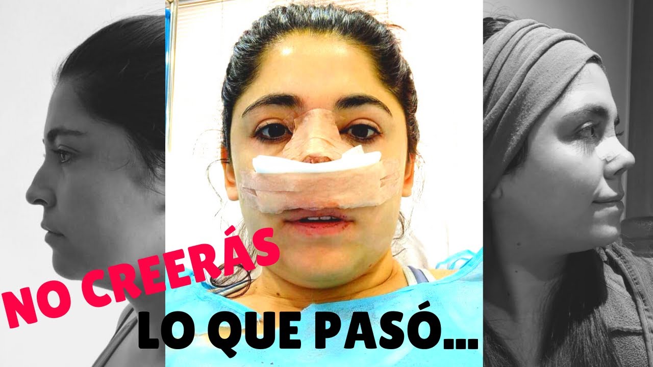 RINOPLASTIA en Cuarentena PRIMAESTETICA 2021-Santiago de ...