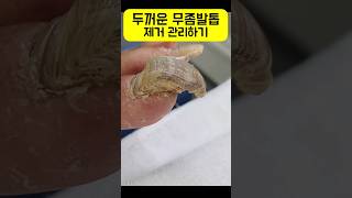 두꺼운 무좀 발톱 제거 관리 #발톱무좀제거 #두꺼운발톱