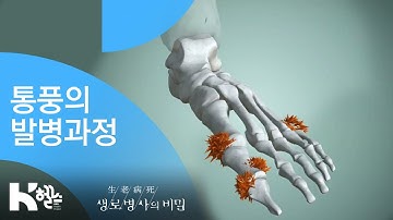 통풍의 발병과정 - (20181031_668회 방송) 내가 키운 고통, 통풍의 오해와 진실