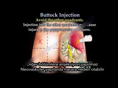 injection buttock enjeksiyon yaplr nasl