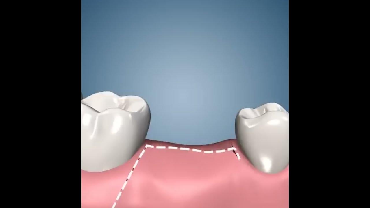 имплантация легких. подкожный кардиовертер дефибриллятор. имплантация легких. зубной имплантат astra tech. имплантация легких.