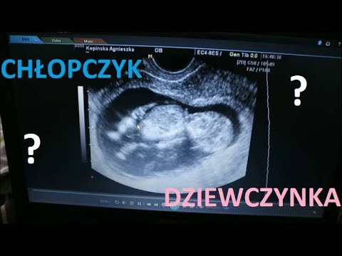 Chlopczyk Czy Dziewczynka 13 Tydzien Mama Ma Wychodne 29 03 18 Youtube