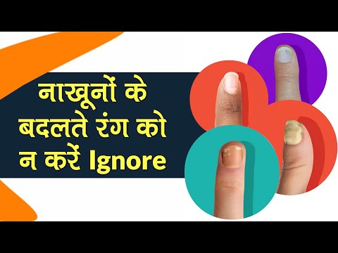 वीडियो: रंगीन नाखूनों का क्या कारण है?