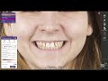 #exocad smile design