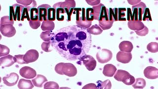 Macrocytic Anemia (updated 2021) - CRASH! Medical Review Series