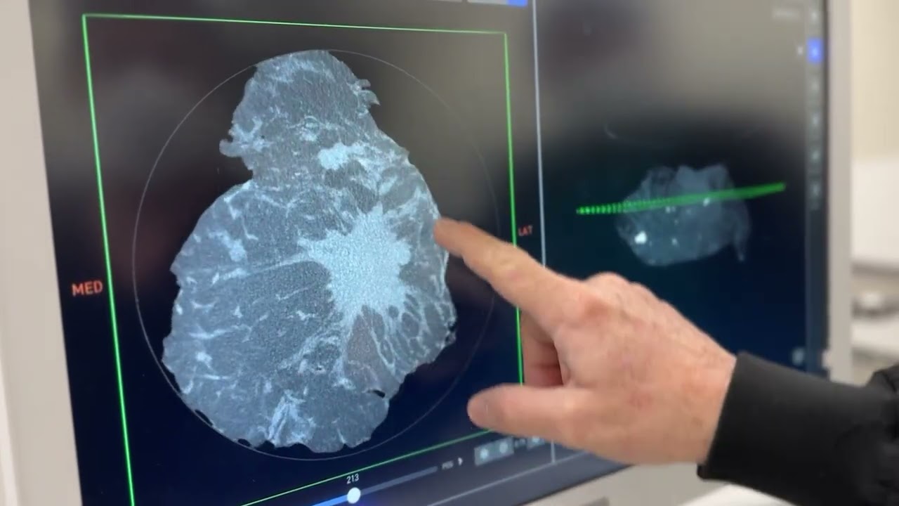 Впервые в Вашингтоне: трехмерная визуализация раковых заболеваний в режиме реального времени в ме...
