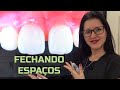 #98 Fechamento de espaços entre os dentes - DIASTEMAS