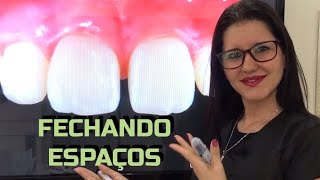 #98 ESPAÇO ENTRE OS DENTES - DIASTEMAS