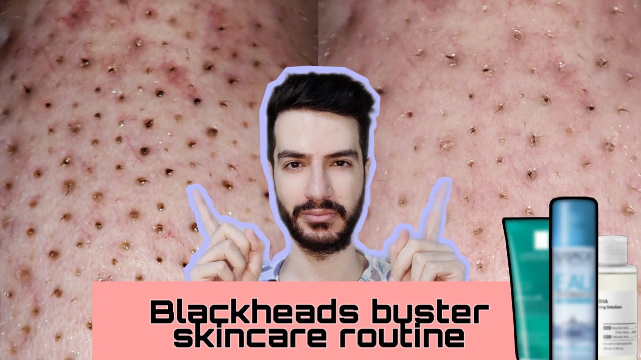 My stable salicylic acid/Tretinoin skincare routine Blackheads buster