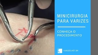 Cirurgia de varizes - www.vascularweb.com.br