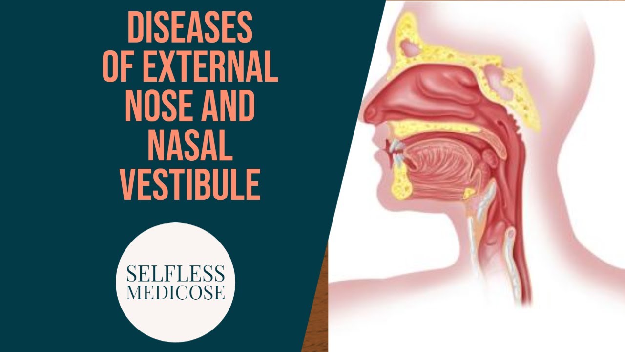 DIEASES OF EXTERNAL NOSE And NASAL VESTIBULE With Important Questions DIEASES OF EXTERNAL NOSE And NASAL VESTIBULE With Important Questions