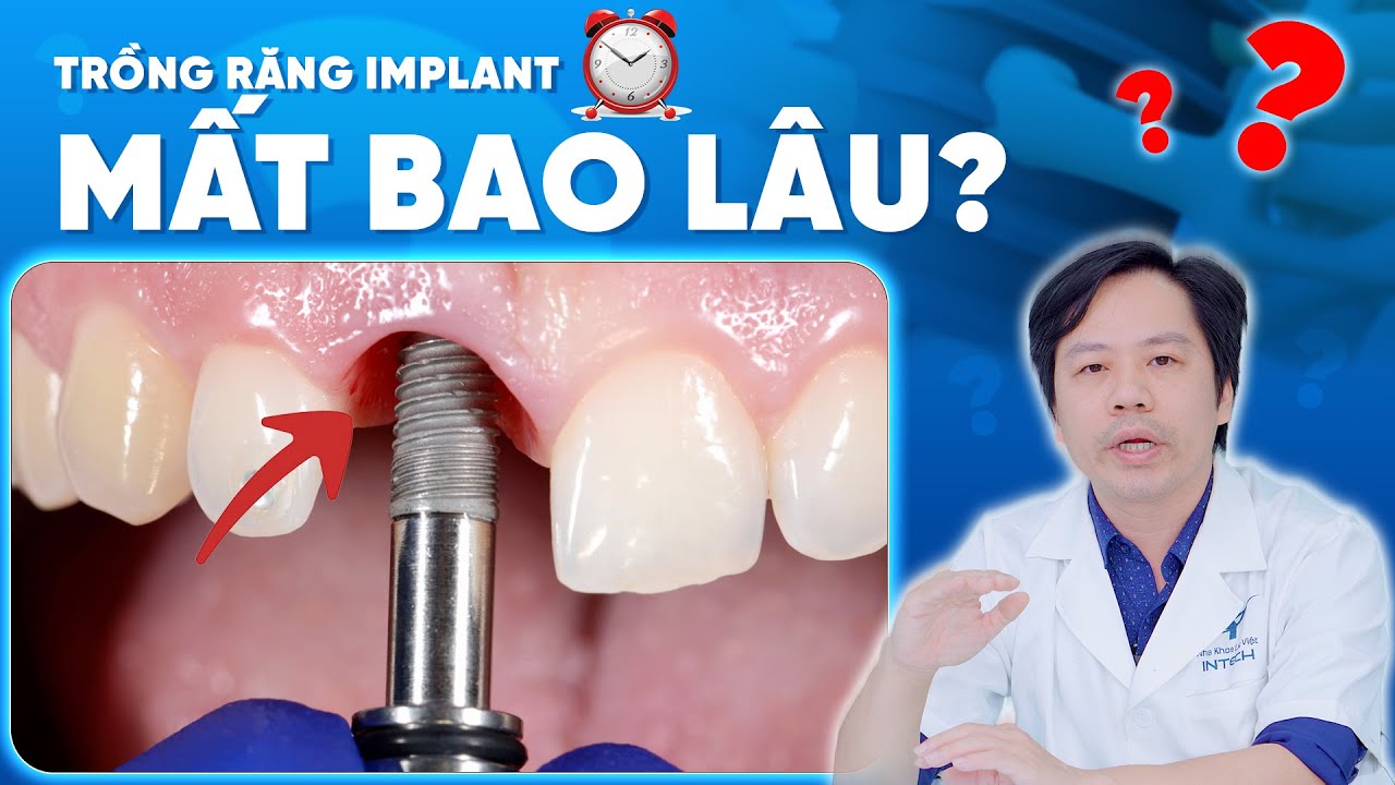 Outline Video Trồng Răng Implant Mất Bao Lâu? Liệu Có Lắp Răng Ngay Sau Khi Đặt Trụ Implant Như "Lời Đồn"?
