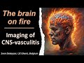 Imaging of cerebral vasculitis