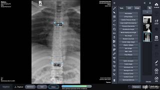 Vertebral Line Chiropractic Tools