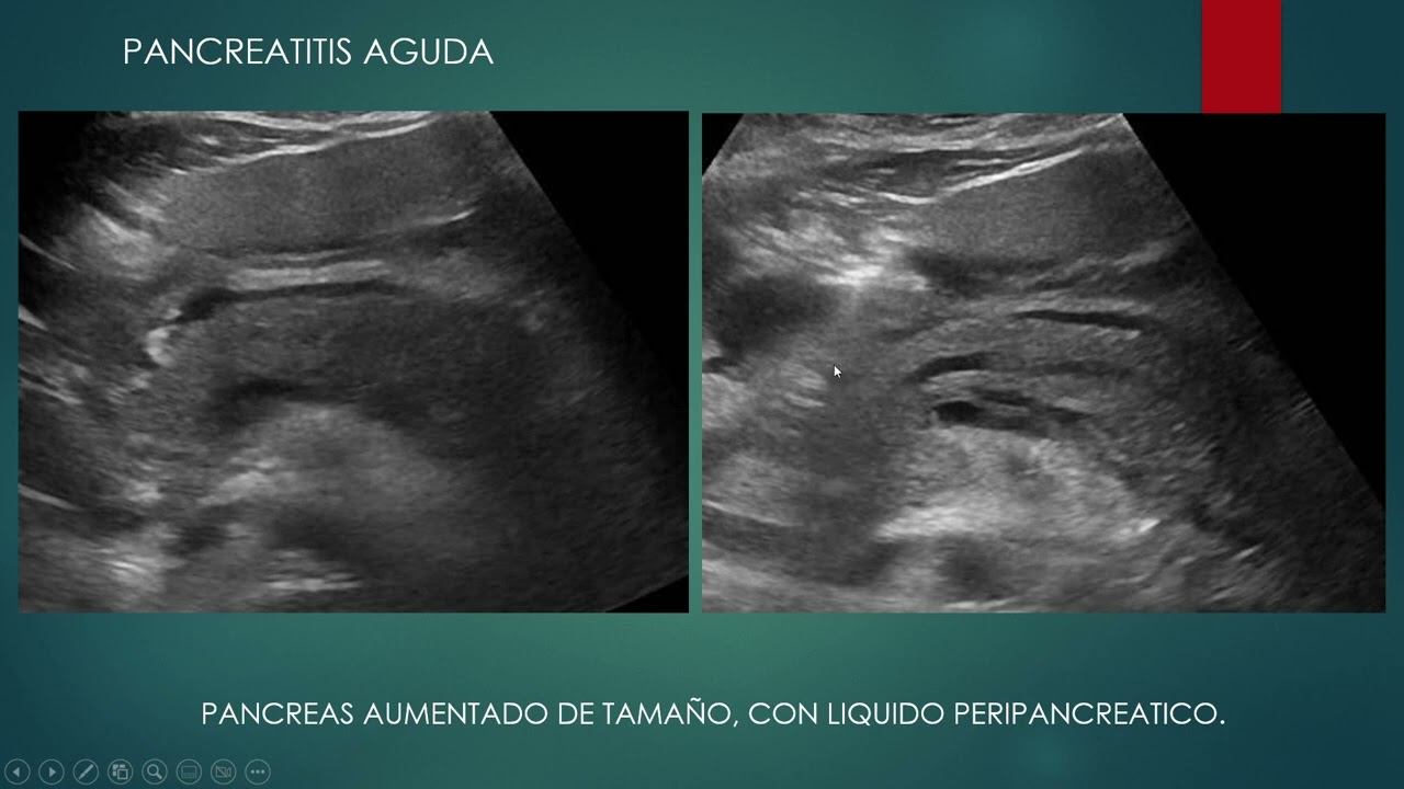 ECOGRAFIA DEL PANCREAS RESUMEN