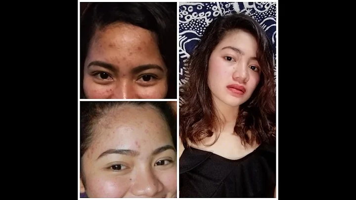 How I got rid of my acne?!