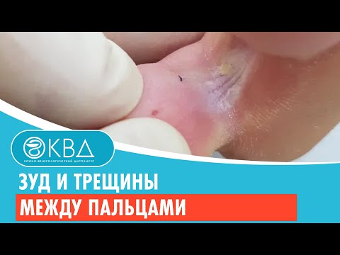 Как избавиться от грибка ног между пальцами в домашних условиях