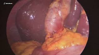 31122018 Laparoscopic Cholecystectomy for Acute Hydropic Cholecystitis 1448