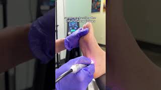 Plantar Fasciitis Laser Treatment