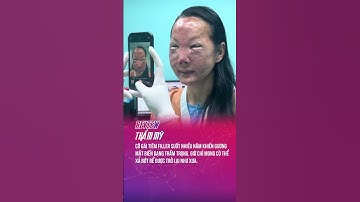 Hậu quả việc lạm dụng filler #tintuc24h #reviewthammy #filller #fyp