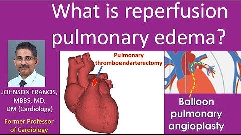 What is reperfusion pulmonary edema?