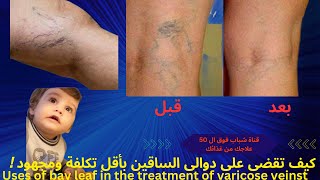 ورق الغار وفائدتة فى علاج دوالى الساقين-Bay leaf and its benefits in the treatment of varicose veins