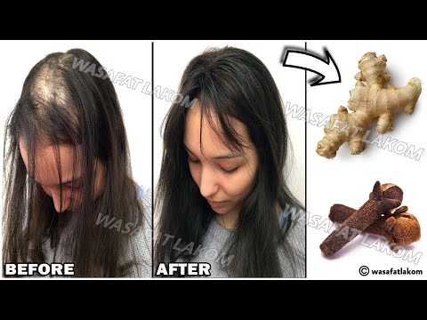 Mix cloves with ginger.🌿 the Indian secret to make hair grow fast and treat baldness.