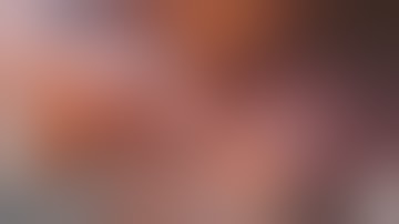 Xi Robotic Left Apical Trisegmentectomy for Lung Cancer with FireFly