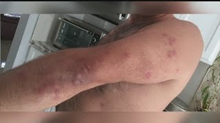 Man complains of possible bed bug bites after hotel stay in North Charleston