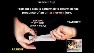 Froment's Sign - Everything You Need To Know - Dr. Nabil Ebraheim