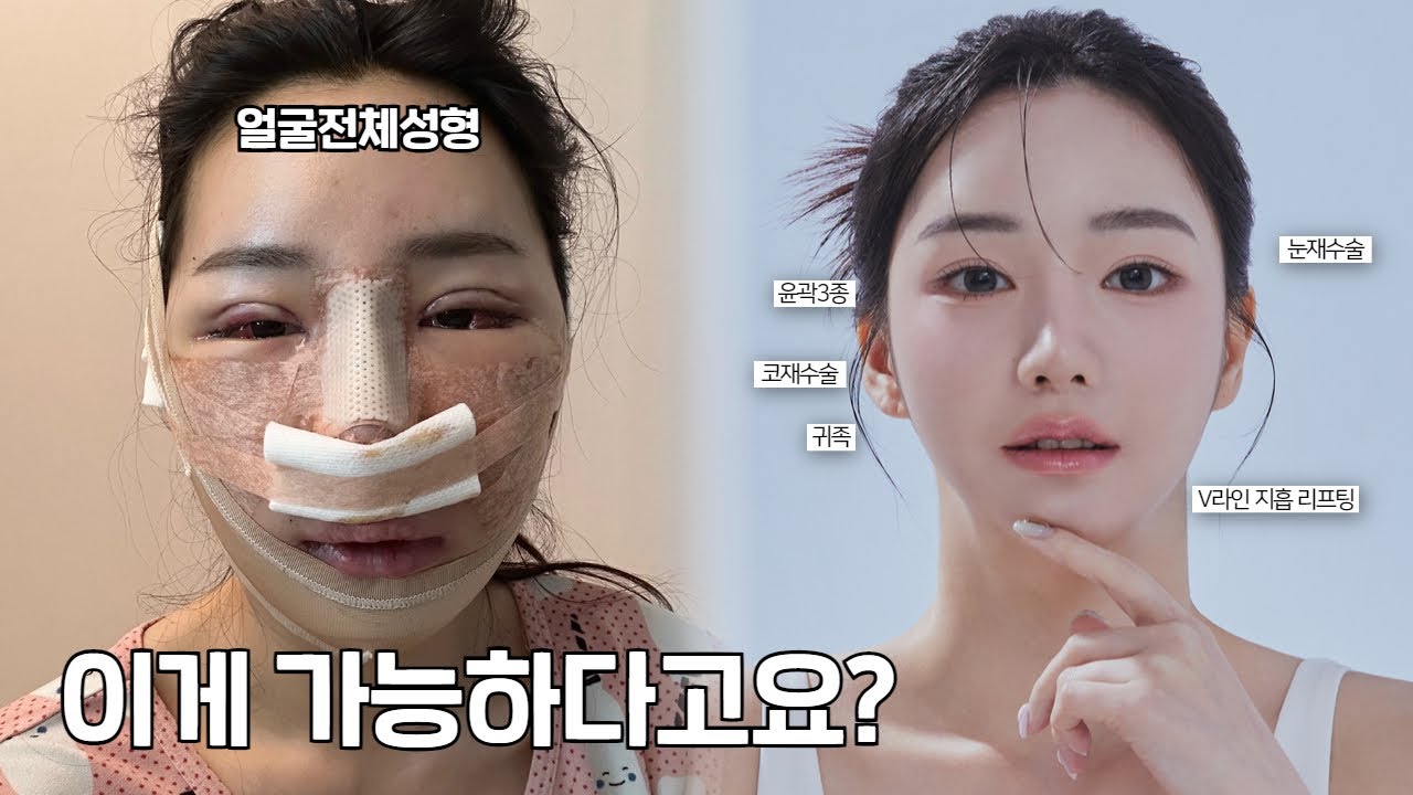 얼굴 전체 성형 후 신세경 닮은 여신 외모로 변신!😎 | 눈 + 코 + 듀얼트임 + 귀족 + 실리프팅 + 윤곽3종