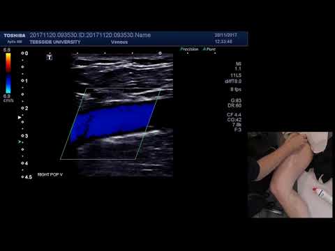 Image of How to scan the leg for DVT